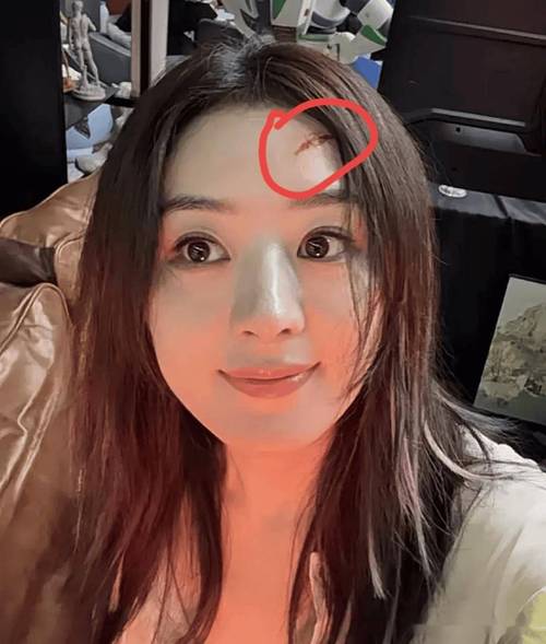 额头有疤的女明星_额头有疤的成功人士_哪些女明星额头有疤
